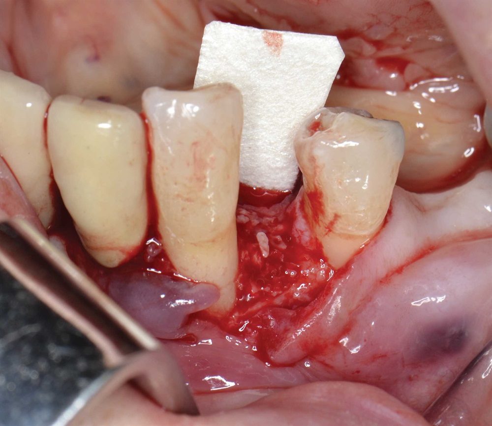 Tarquini_Periodontal intrabony defect